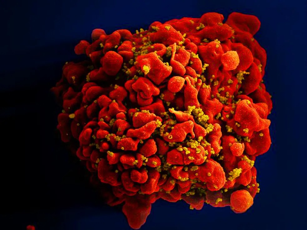 Avanço contra o HIV: pesquisadores anunciam dois novos casos de remissão